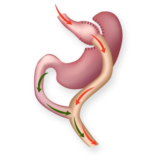 Roux-en-Y Gastric Bypass surgery diagram