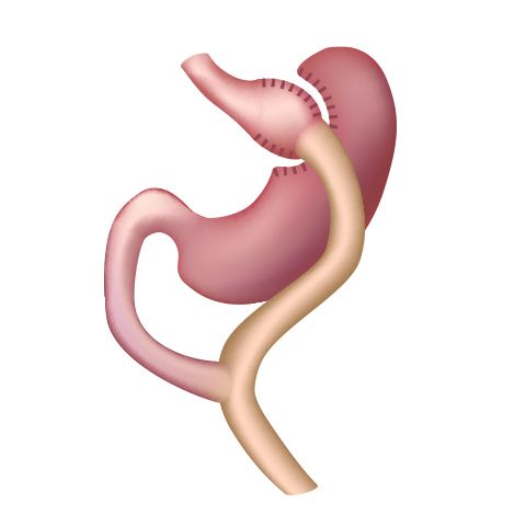 Gastric bypass surgery in Mexico