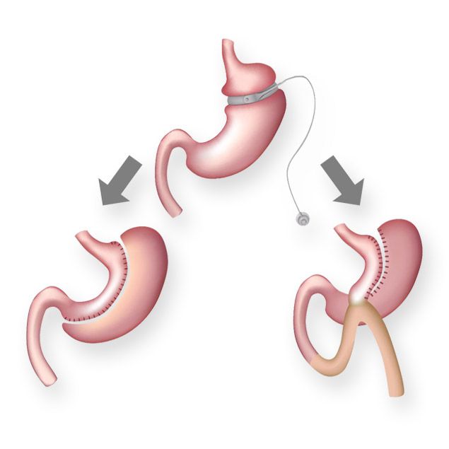 Bariatric revision surgery in Mexico