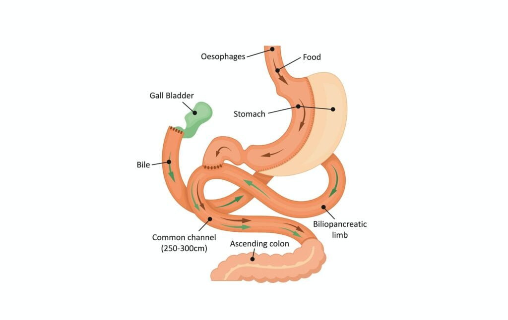 SADI-S surgery