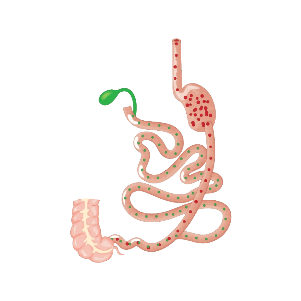 Duodenal switch