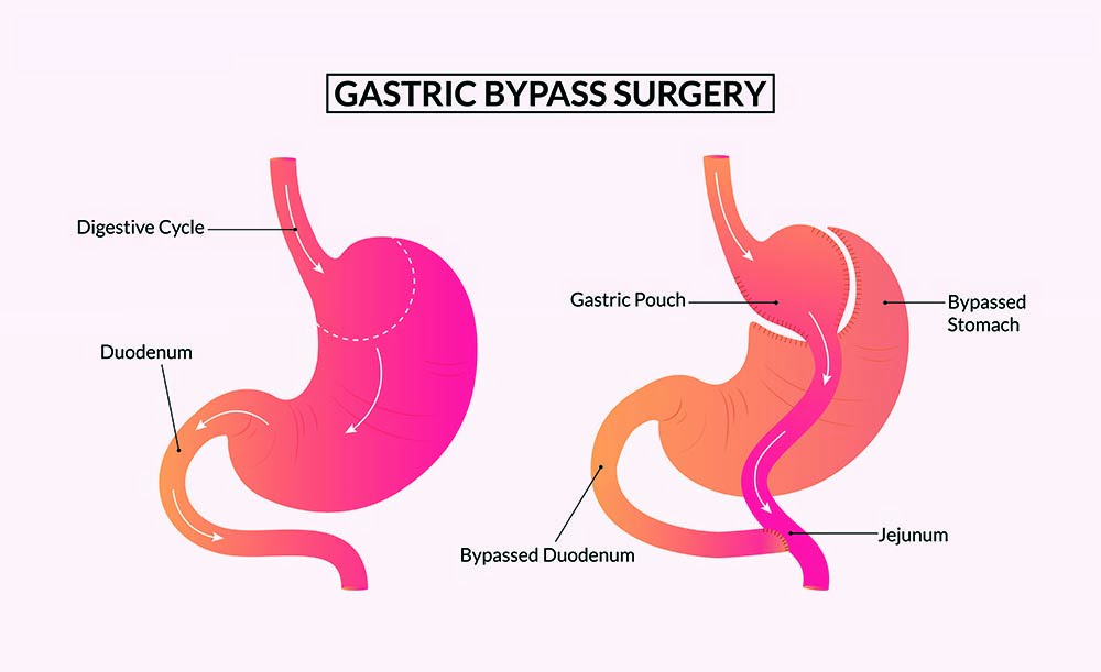 Gastric bypass surgery