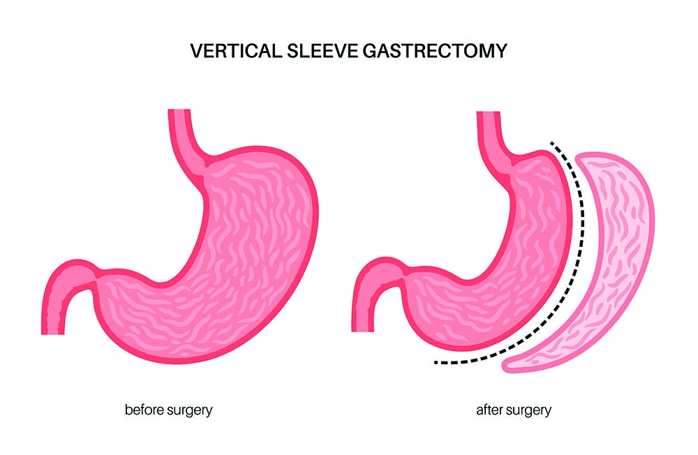 Gastric sleeve surgery