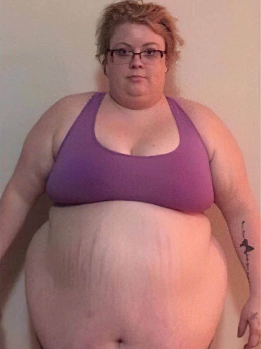 Before Gastric Sleeve