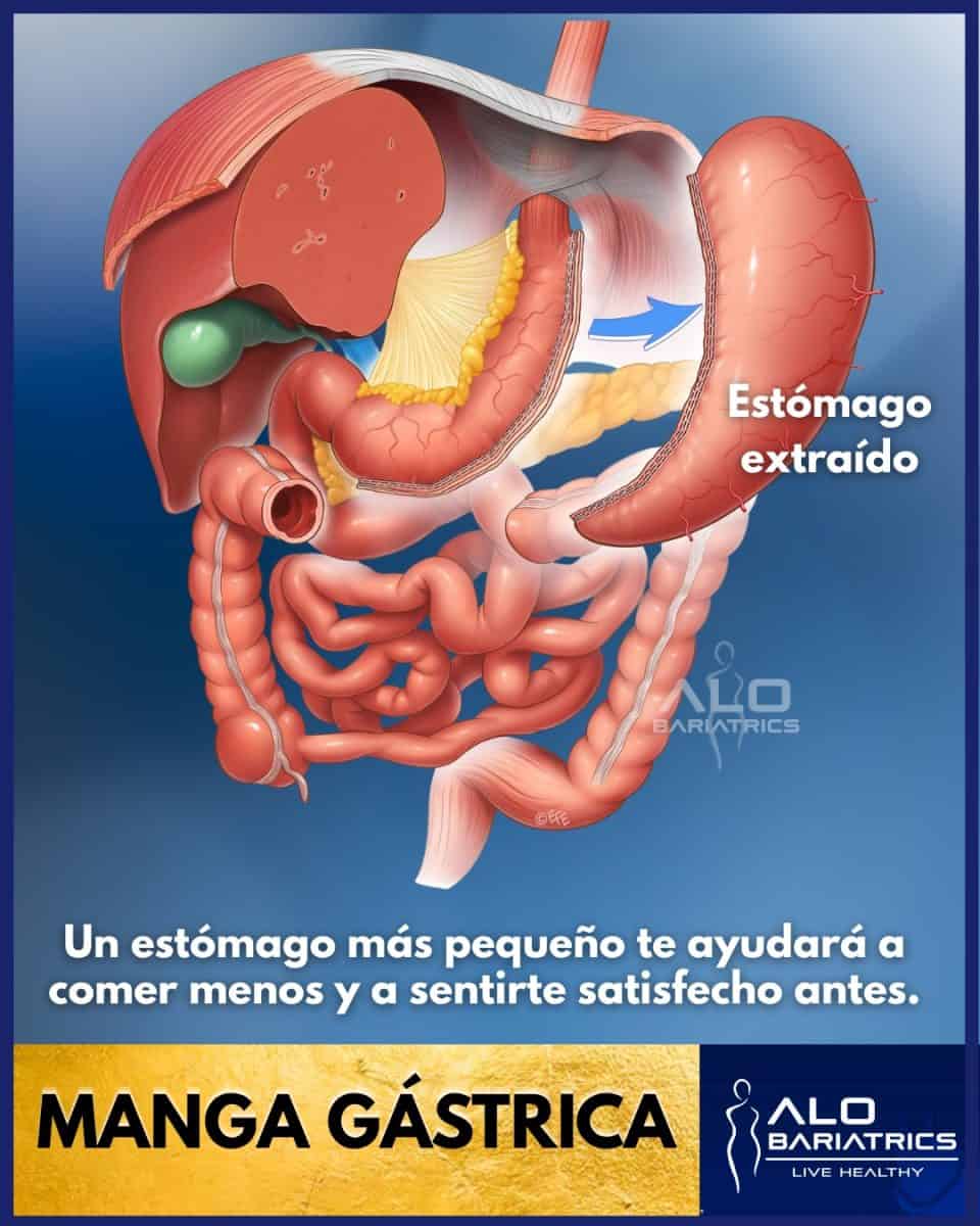 Manga Gástrica