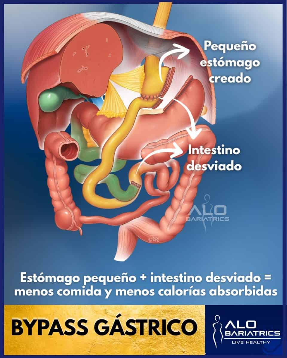 Bypass Gástrico Roux-en-Y