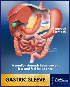 Gastric Sleeve Surgery in Tijuana, Mexico - ALO Bariatrics (Gastric Sleeve Page)