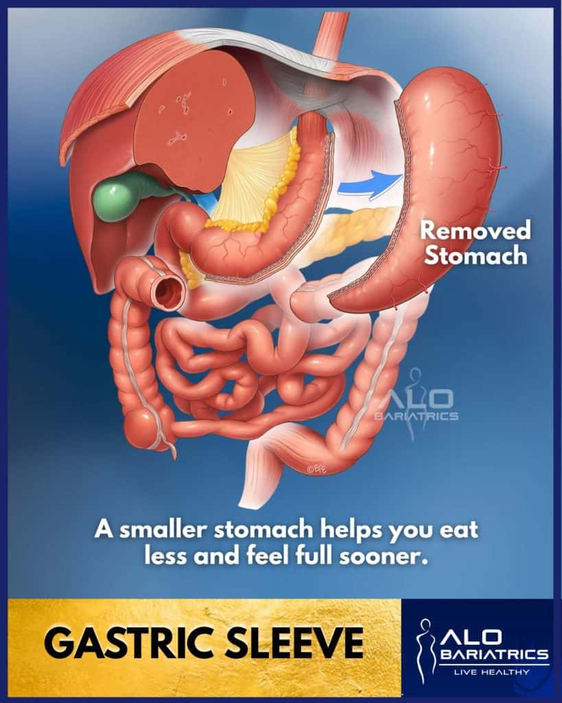 Gastric Sleeve Surgery in Tijuana, Mexico - ALO Bariatrics (Gastric Sleeve Page)