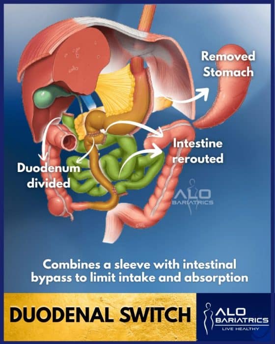 Duodenal switch surgery diagram — Bariatric procedure in Mexico ALO Bariatrics