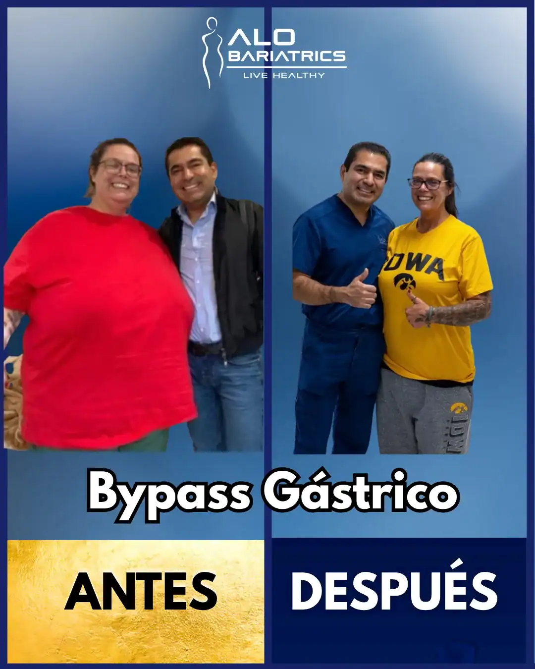 Antes y después — paciente bypass gástrico