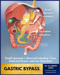 Gastric bypass surgery Mexico — Roux-en-Y procedure ALO Bariatrics