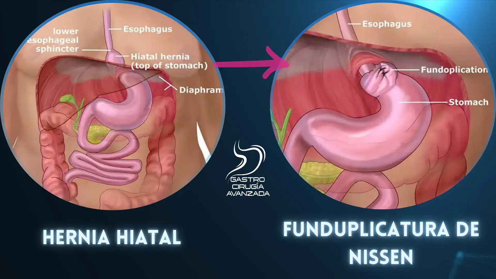 Hernia hiatal y funduplicatura de Nissen