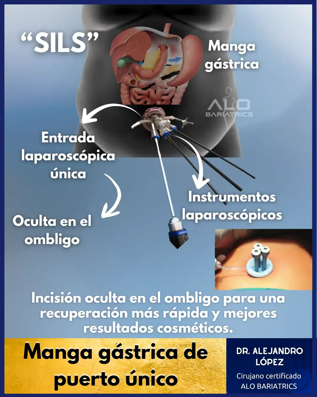 Manga Gástrica SILS Puerto Único