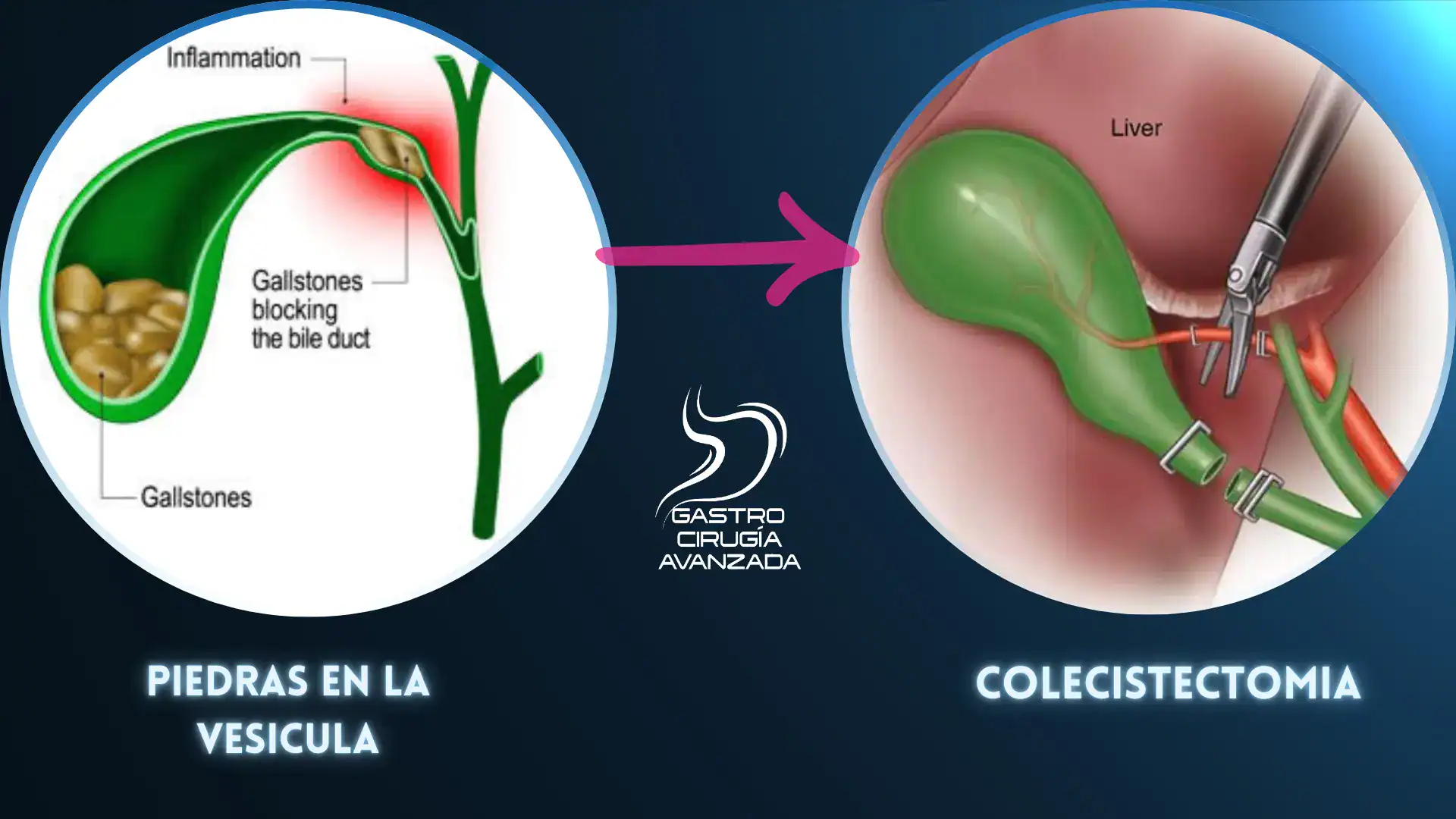 Colecistectomía laparoscópica para piedras en vesícula