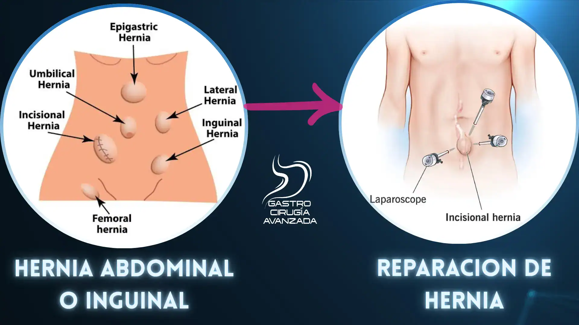 Reparación de hernia abdominal e inguinal