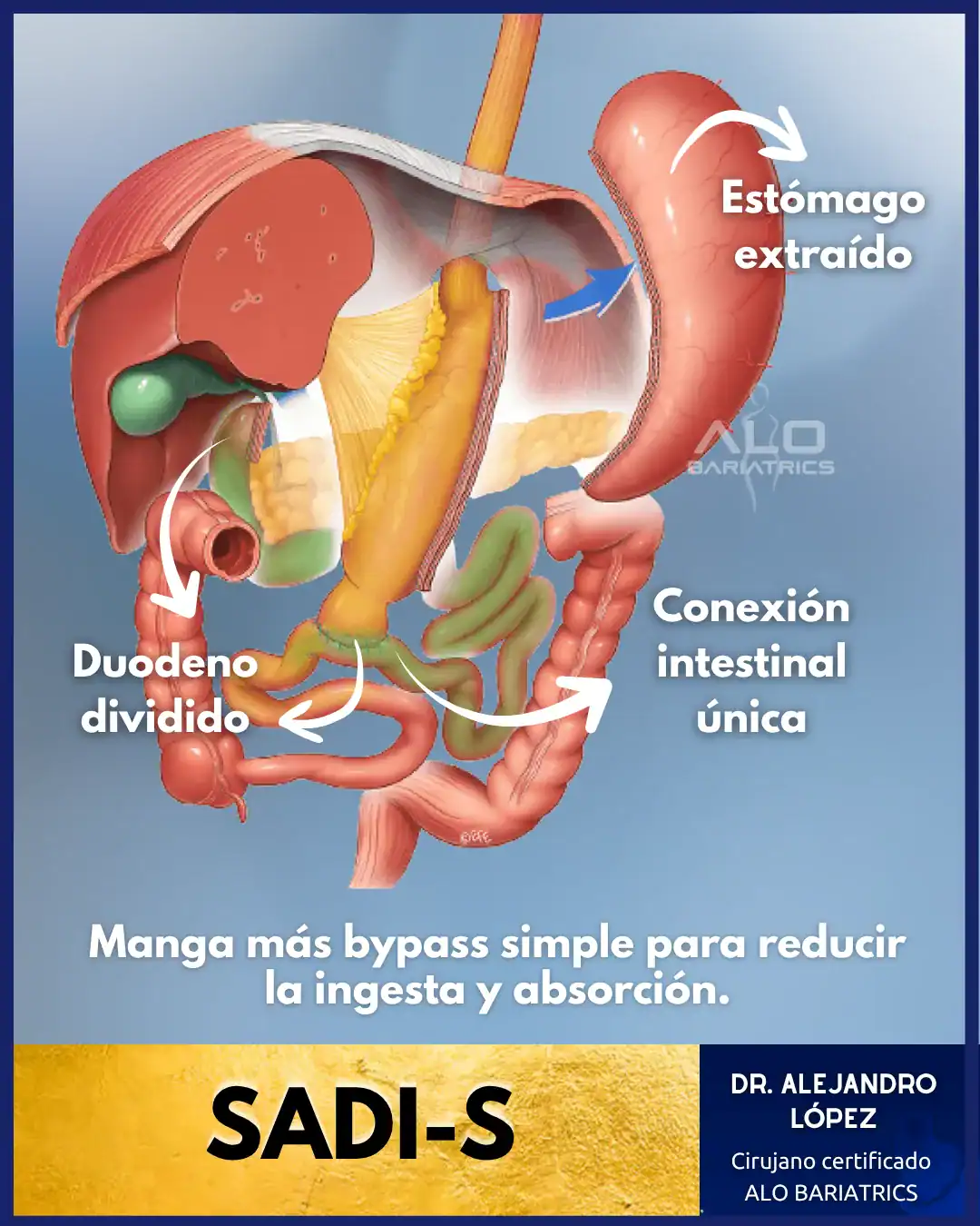 Cirugía SADI-S en México