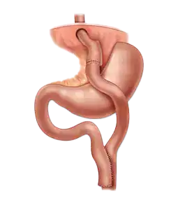 Roux-en-Y gastric bypass anatomy showing how the reroute keeps acid away from the esophagus