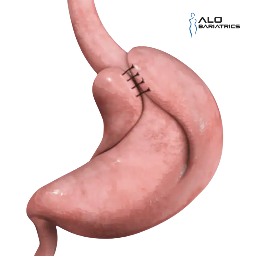 Nissen fundoplication diagram showing the wrap around the lower esophagus