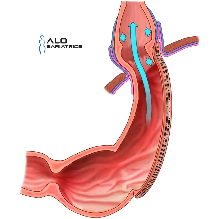 Gastric sleeve anatomy creating high pressure that pushes acid into the esophagus