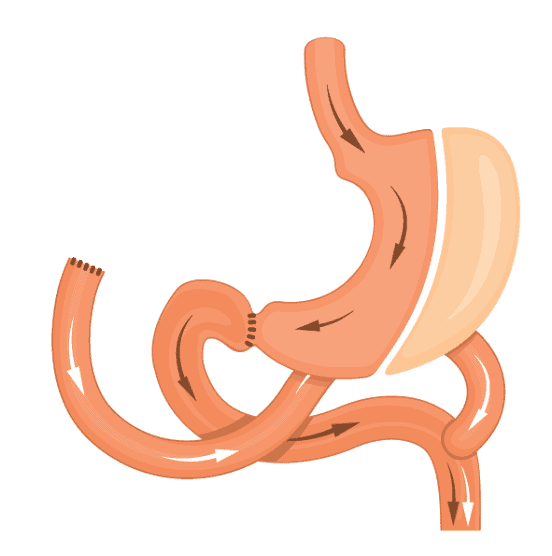 Cruce Duodenal
