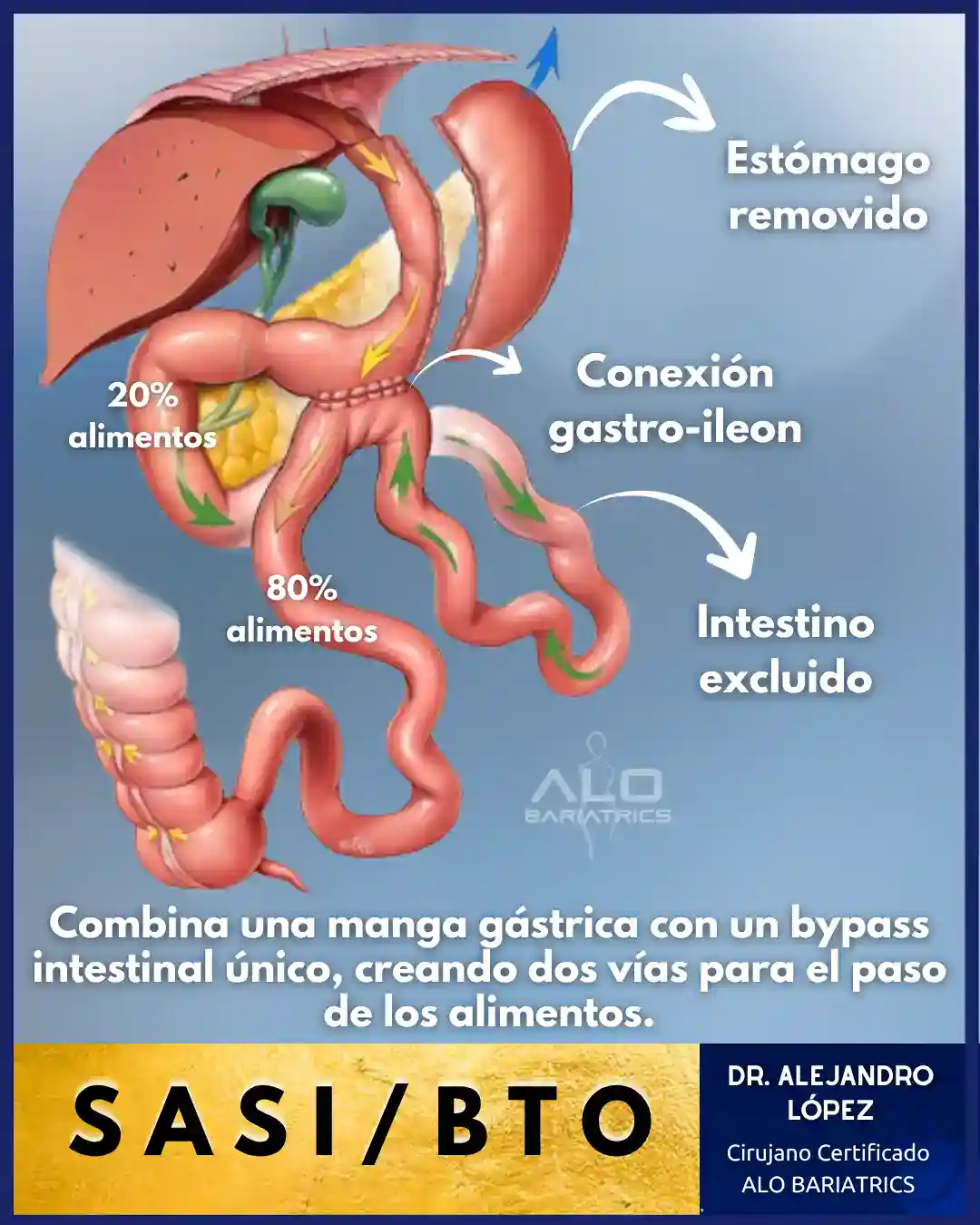 Diagrama Bipartición Intestinal (SASI)