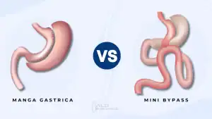 MANGA VS MINI BYPASS