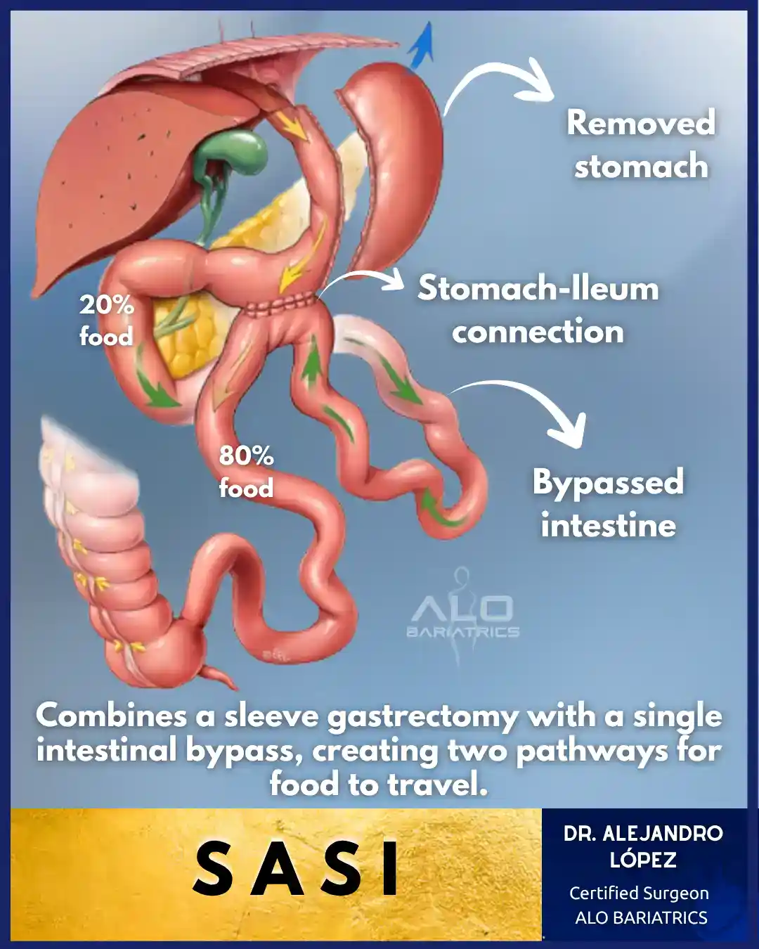 SASI Surgery Diagram — Single-Anastomosis Sleeve Ileal Bypass