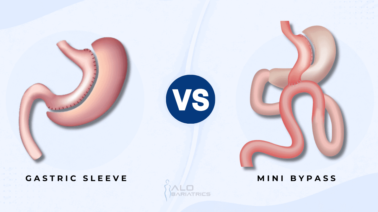 Mini gastric bypass vs gastric sleeve comparison
