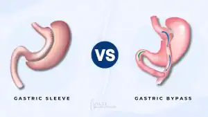 Gastric Sleeve Vs Gastric Bypass