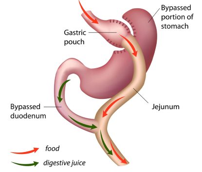 Gastric Bypass Image Gastric Bypass Image