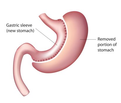 Gastric Sleeve Image Gastric Sleeve Image