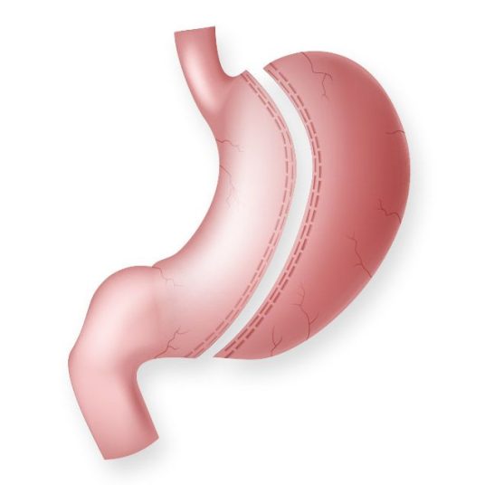 Gastric Sleeve Revision Gastric Sleeve Revision