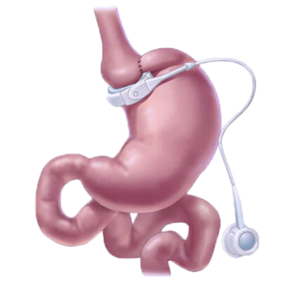 LAP-BAND Surgery LAP-BAND Surgery