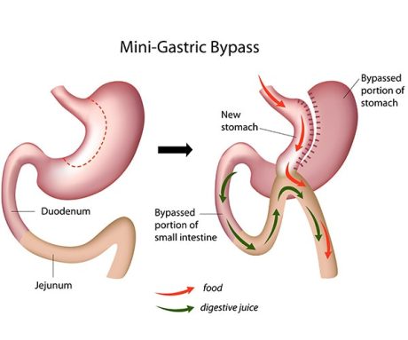 Mini Gastric Bypass_IMG Mini Gastric Bypass_IMG